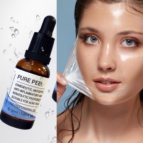Chemical Acid Peeling